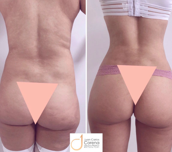 Gluetoplastia 6 antes y después de gluteoplastia