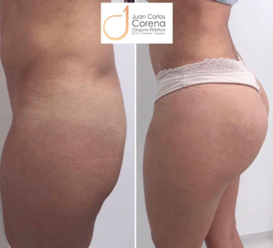 Gluetoplastia 4 antes y después de gluteoplastia