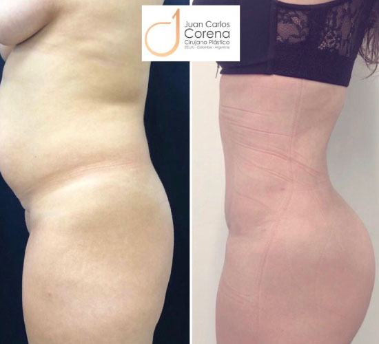 Gluetoplastia 2 antes y después de gluteoplastia
