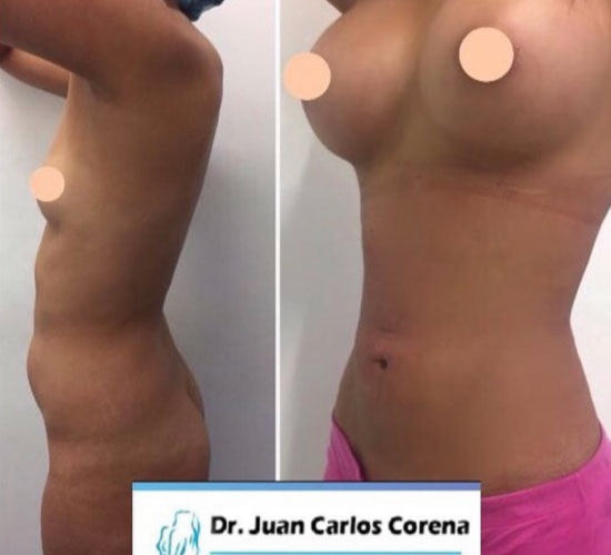 antes y después de mamoplastia de aumento