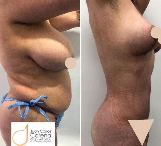 antes y después de mamoplastia de reducción. dr juan carlos corena