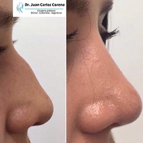 Cirugía de la Nariz 15 Antes y después de rinoplastia Dr. Juan Carlos Corena