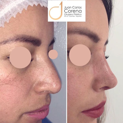 Cirugía de la Nariz 17 Antes y después de rinoplastia Dr. Juan Carlos Corena