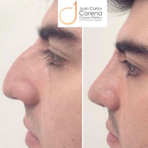 Cirugía de la Nariz 18 Antes y después de rinoplastia Dr. Juan Carlos Corena